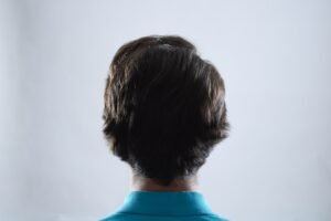 Photo hair loss causes